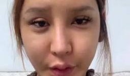整容失败脸很鼓的网红吃瓜,美丽代价太大！